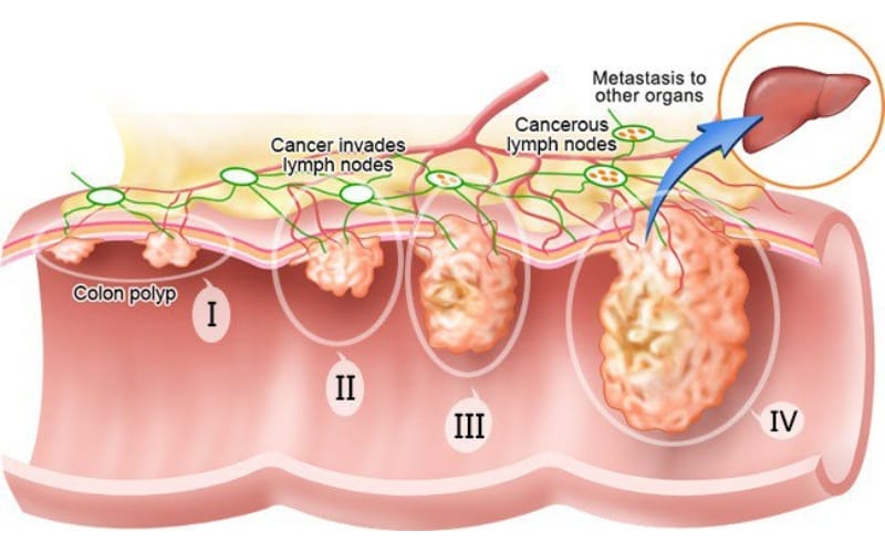 Các giai đoạn ung thư và vai trò của Xáo tam phân trong hỗ trợ điều trị
