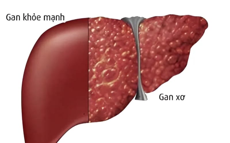 Dấu hiệu gan bị tổn thương và cách Xáo tam phân hỗ trợ phục hồi