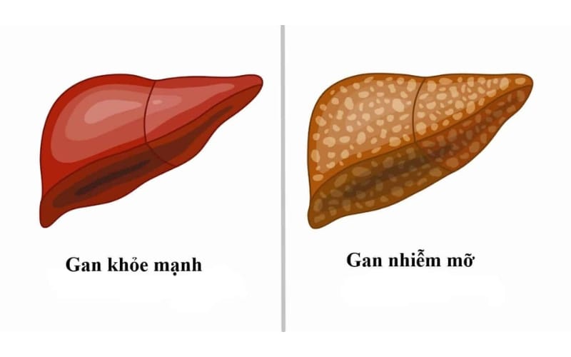Gan nhiễm mỡ có nguy hiểm không? Xáo tam phân hỗ trợ điều trị như thế nào?