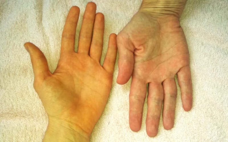 Gan nhiễm mỡ có nguy hiểm không? Xáo tam phân hỗ trợ điều trị như thế nào?